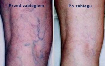 Żylaki i pajączki żylne - problem zdrowotny